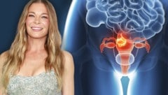 Bösartige Tumore der Gebärmutter sind häufige Krebserkrankungen der weiblichen Genitalorgane. LeAnn Rimes musste sich nun wegen einer Vorstufe von Gebärmutterhalskrebs operieren lassen. (Bild: Krone KREATIV, APA/Getty Images via AFP/GETTY IMAGES/Emma, stock.adobe.com)