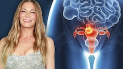 Bösartige Tumore der Gebärmutter sind häufige Krebserkrankungen der weiblichen Genitalorgane. LeAnn Rimes musste sich nun wegen einer Vorstufe von Gebärmutterhalskrebs operieren lassen. (Bild: Krone KREATIV, APA/Getty Images via AFP/GETTY IMAGES/Emma, stock.adobe.com)