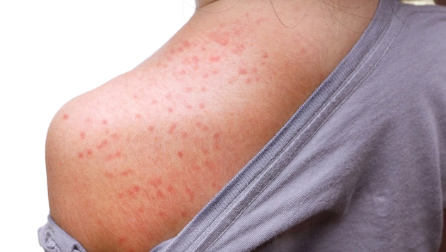 Cases of measles are currently on the rise. (Bild: weerapat1003/stock.adobe.com)