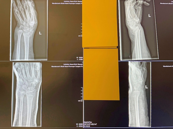 Im Röntgen gut sichtbar: verletzte Hand nach einem Sturz auf Glatteis in Oberwart.