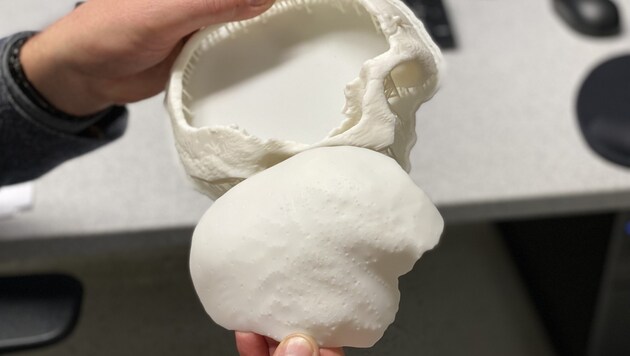W Szpitalu Uniwersyteckim w Salzburgu zbudowano sztuczną czaszkę przy użyciu drukarki 3D. (Bild: APA/SALK/WOLFGANG FRWEGER)