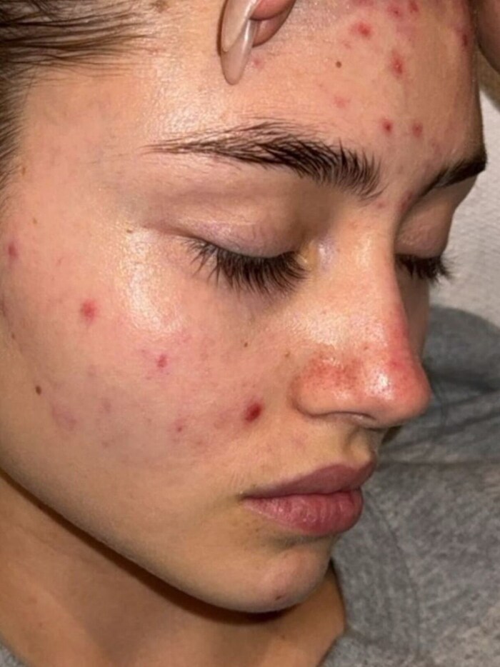 In ihrer Instagram-Story zeigte sich Leni Klum jetzt mit zahlreichen Pickeln im Gesicht.