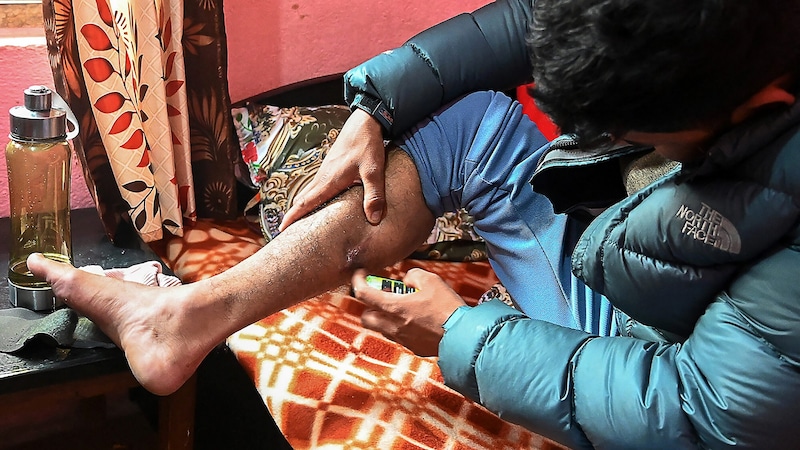 Ein nepalesischer Söldner zeigt eine Verletzung, die er an der Front erlitten hat. (Bild: APA/AFP/Prakash MATHEMA)