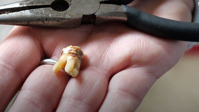 Erinnerung an die Selbst-OP
