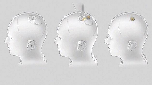 Neuralinks anfängliches Ziel besteht darin, Menschen in die Lage zu versetzen, einen Computercursor oder eine Tastatur allein durch ihre Gedanken zu steuern. (Bild: APA/AFP/Neuralink)