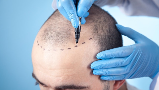 Kel kafalar ve azalan saç çizgileri birçok yurttaş için büyük bir yüktür. (Bild: stock.adobe.com)