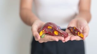 Hepatitis A löst eine Erkrankung der Leber aus. (Bild: Jo Panuwat D - stock.adobe.com / KroneMED)