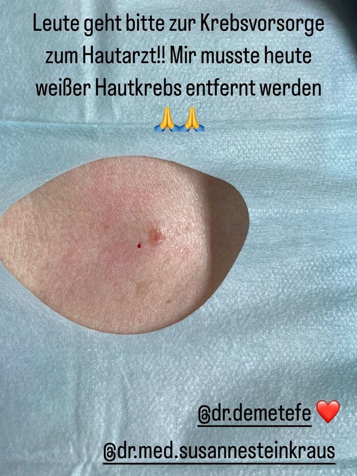 Mirja du Mont rief ihre Follower auf, zum Hautarzt zu gehen und ein Check-up zu machen.