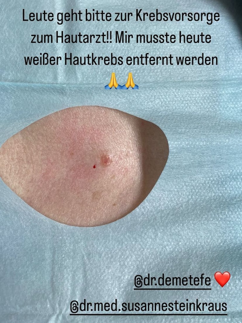 Mirja du Mont called on her followers to go to the dermatologist and have a check-up. (Bild: www.instagram.com/mirja_du_mont/)