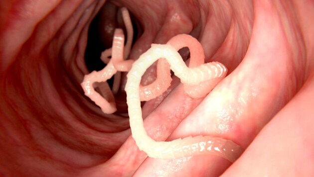 Un ver solitaire dans un intestin humain - lorsqu'une telle petite bête se fixe dans le cerveau, c'est encore plus désagréable. (Bild: Juan Gärtner, stock.adobe.com)