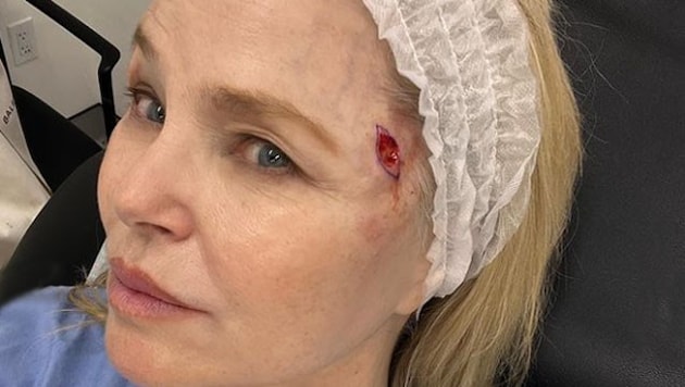 Christie Brinkley teilt ihre Erfahrung mit Hautkrebs ungeschönt. Ihr wurde – wie das Foto zeigt, über der Schläfe in Basalzellkarzinom entfernt. (Bild: www.instagram.com/christiebrinkley)