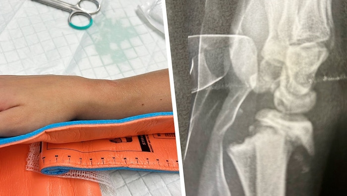 The complicated fracture was very painful.