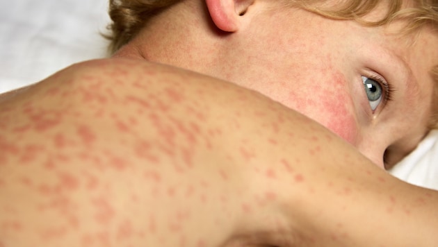 Measles is more than just a "harmless" childhood disease (Bild: Aleksandr - stock.adobe.com)