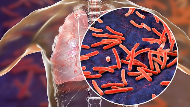 Tuberculosis bacteria usually migrate to the lungs. (Bild: Dr_Microbe/stock.adobe.com)