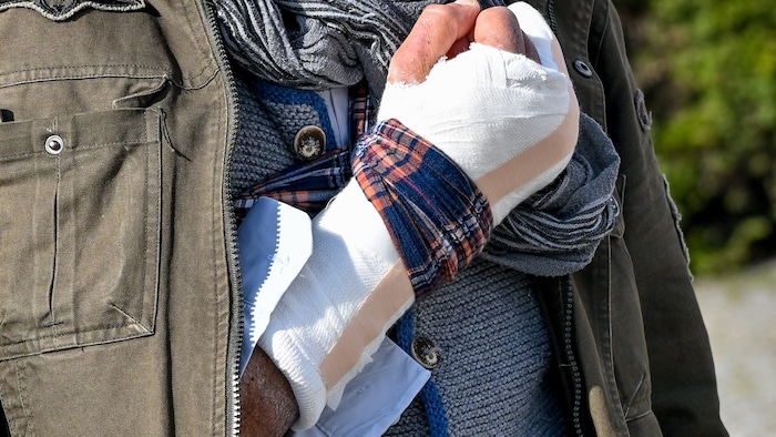 The metacarpal bone in his right hand was broken in the kick.