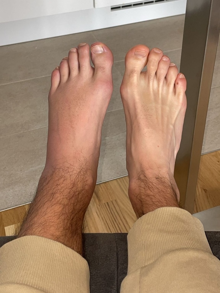 Is the bite of a spiny-fingered spider to blame? The swollen foot on the left, the normal side ...