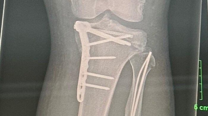 Das linke Knie von Krenn wurde im UKH Graz verschraubt – nicht die letzte OP.