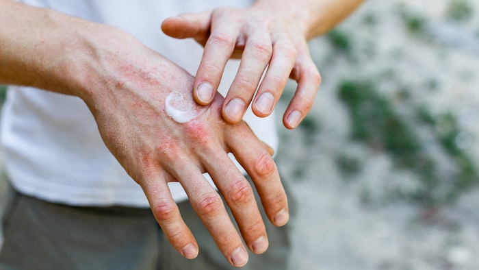 Cortisone ointments are often essential for eczema, but UV radiation and medication are also ...