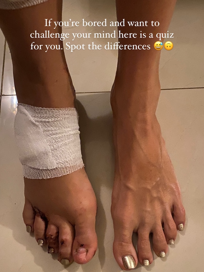 Laura Weyel shared a photo of her damaged feet after the accident.