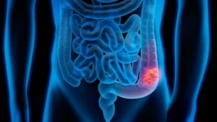 Ist es Darmkrebs? Das lässt sich anhand von Gewebeproben, die bei der Vorsorgeuntersuchung entnommen werden, erkennen. (Bild: peterschreiber.media/stock.adobe.com)