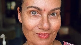Nach zwei Wochen mit harten Medikamenten zeigt Jenny Jürgens noch vorhandene Wunden ihrer ...
