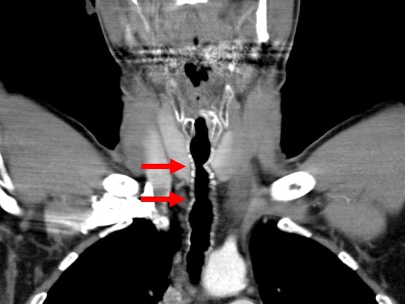Hastanın bilgisayarlı tomografi görüntüsü: 2006 yılında doktorlar trakeal duvarda da bir daralma keşfetti (kırmızı oklar). (Bild: American Journal of Case Reports)
