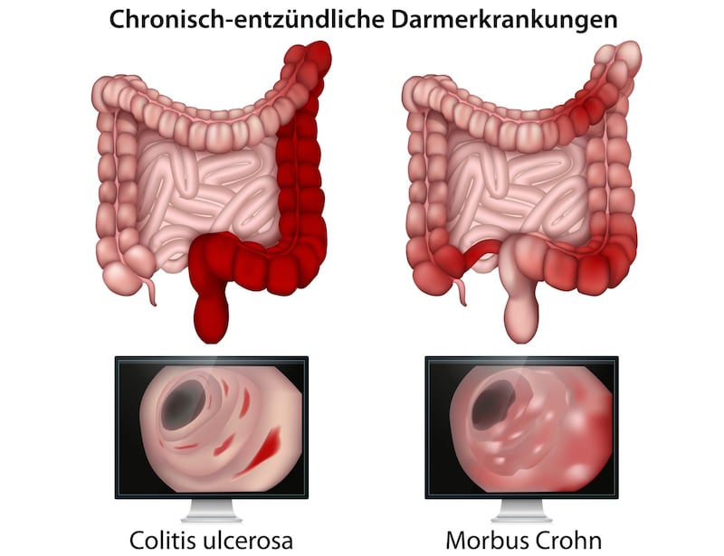 Bei Colitis ulcerosa (CU) handelt es sich um eine Dickdarmentzündung mit Geschwürbildung, bei Morbus Crohn um eine dauerhafte Entzündung und Schädigung im Verdauungstrakt – vom Mund bis zum After. (Bild: stock.adobe.com/bilderzwerg - stock.adobe.com)