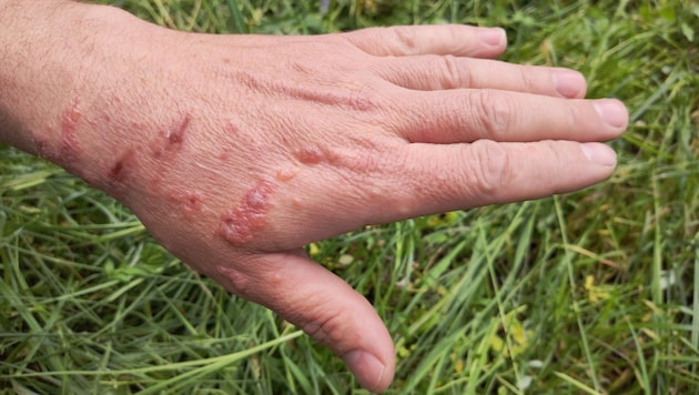 In combination with sunlight, the plant sap can cause severe inflammation or burns on the skin. (Bild: stock.adobe.com/dero2084)