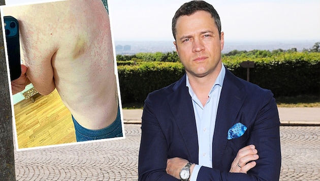 "Ibiza protagonist" Johann Gudenus defends himself in the "Krone" interview and shows his injuries. (Bild: Krone KREATIV/Martin Jöch,l ZvG.)