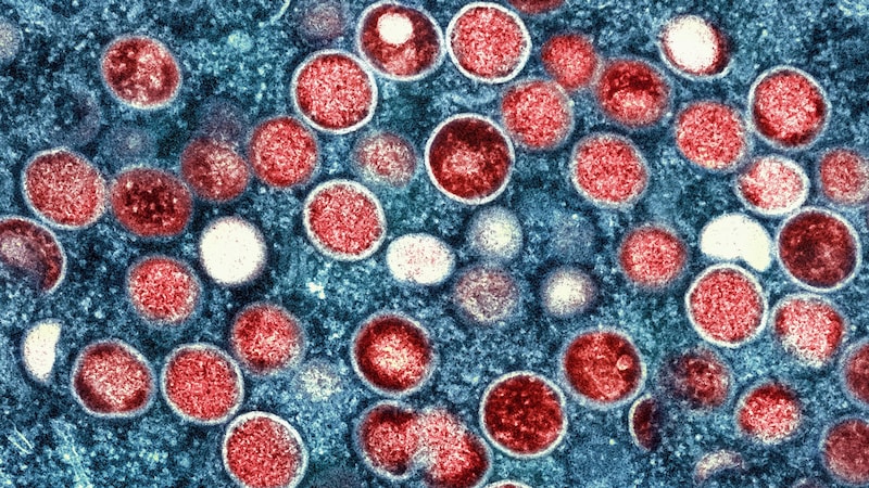 Mpox-Virus  (Bild: AP)