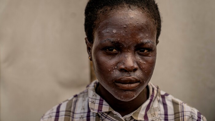 Mpox can be transmitted through physical contact with an infected person, with contaminated material (e.g. clothing, bedding) or with infected animals.