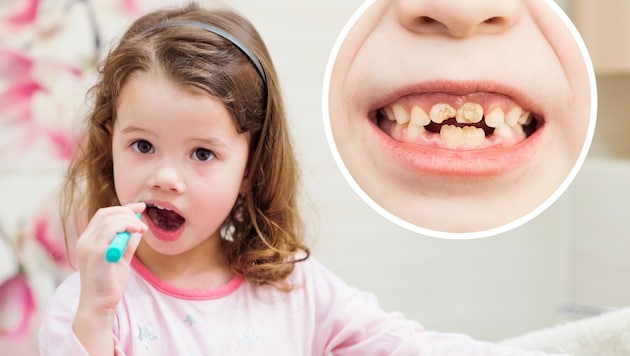 Whitish to yellow-brown spots and crumbly: what are chalky teeth all about? We have asked! (Bild: Stock Adobe (2), Krone KREATIV)