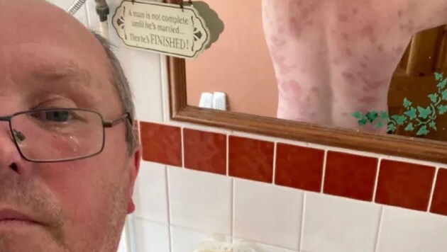 Andrew Powell (57) shows the stitches on his back. (Bild: Facebook.com/Andrew Powell)