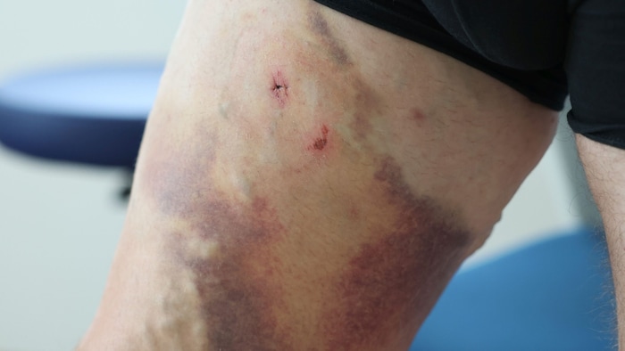 The procedure on the leg - the femoral vein was punctured and a 30 cm long stent was inserted with a wire. 
