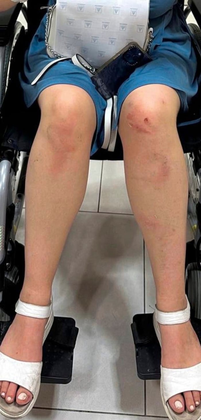 The young woman had to be treated in hospital.