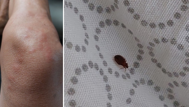 The woman counted over 500 bedbug bites all over her body. (Bild: zVg, Krone Kreativ)