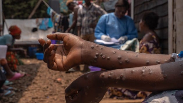 Gen-Analysen zeigen, dass das Mpox-Virus – früher „Affenpocken“ – in Nigeria seit 2015 in menschlichen Populationen zirkulierte. Doch es blieb lang unter dem Radar – mit einem langsamen exponentiellen Wachstum, bei dem sich die Fallzahlen alle zwei Jahre verdoppelt haben. (Bild: AFP/APA/Glody MURHABAZI)