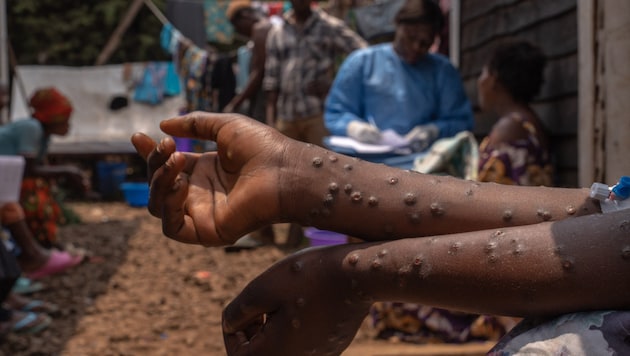 Genetic analyses show that the Mpox virus - formerly known as "monkeypox" - has been circulating in human populations in Nigeria since 2015. However, it remained under the radar for a long time - with a slow exponential growth in which the number of cases doubled every two years. (Bild: AFP/APA/Glody MURHABAZI)