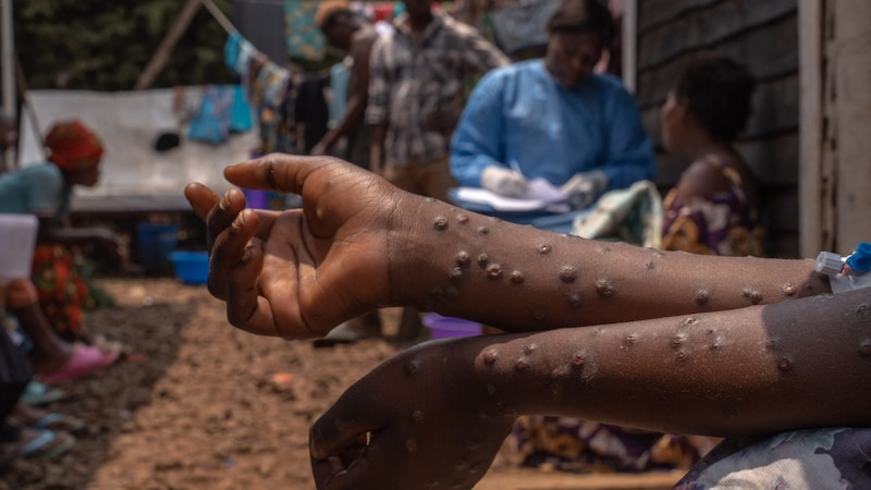 Ein Mpox-Infizierter mit den charakteristischen Pocken (Bild: AFP/APA/Glody MURHABAZI)