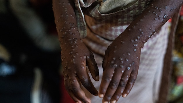 The Democratic Republic of Congo in particular is suffering from Mpox. (Bild: AFP/Glody MURHABAZI)