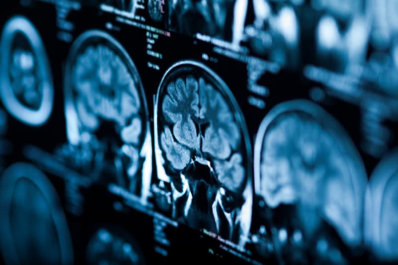 An MRI scan can detect changes in the brain. (Bild: merydolla )