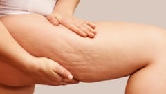 Cellulite, Druckschmerzen und Neigung zu Blutergüssen können auf ein Lipödem hindeuten. (Bild: stock.adobe.com/elenavolf)