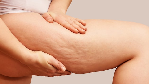 Cellulite, pressure pain and a tendency to bruise may indicate lipoedema. (Bild: stock.adobe.com/elenavolf)