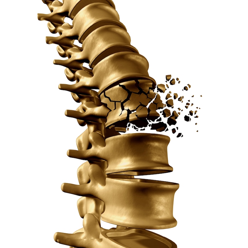 Bei Osteoporose kann es auch zu Frakturen der Wirbelkörper kommen. (Bild: freshidea - stock.adobe.com)