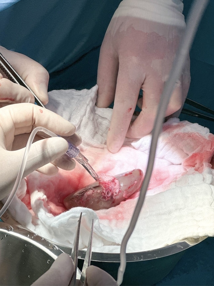 Die Transplantation einer Niere.