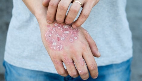 Schuppige Bereiche an sichtbaren Stellen bedeuten eine Belastung für Psoriasis-Betroffene.