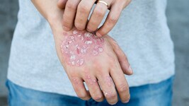 Schuppige Bereiche an sichtbaren Stellen bedeuten eine Belastung für Psoriasis-Betroffene.
