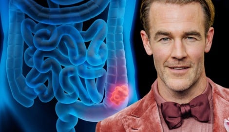 „Dawson‘s Creek“-Star James Van der Beek (47) ist an Darmkrebs erkrankt.