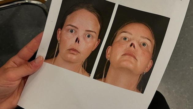 Die Schwedin wurde in einer deutschen Klinik behandelt – in Schweden konnten die Ärzte ihre Nase nicht rekonstruieren. (Bild: instagram.com/charlottaoskarsson)