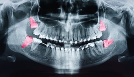 So sehen die Weisheitszähne (in rot) am Röntgenbild aus. (Bild: stock.adobe.com/RADU BERCAN)